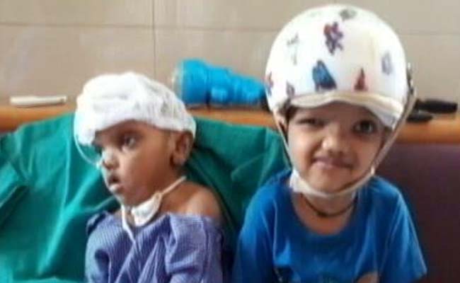 AIIMS का चमत्कार! सिर से जुड़े दो भाइयों को किया अलग-अलग