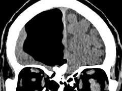 Doctors Find Air Pocket Where Part Of Man's Brain Should Be