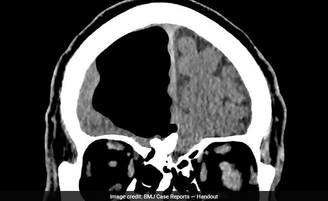 Doctors Find Air Pocket Where Part Of Man's Brain Should Be