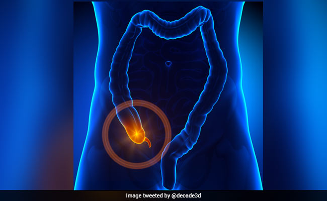 How To Prevent And Treat Appendicitis Naturally