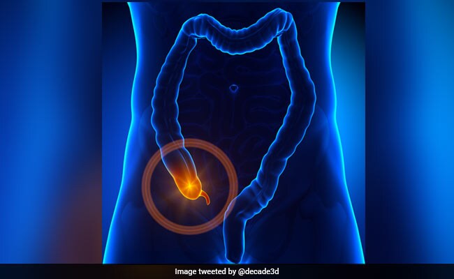 अपेंडिक्स कैंसर का देर से पता लगना बढ़ा सकता है मुश्किलें, जानें क्या कहते हैं डॉक्टर्स