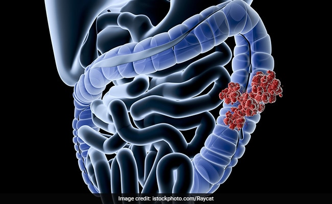 Rise Of Colorectal Cancer Among Young Adults: Know The Causes And Symptoms