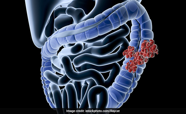 World Cancer Day 2023: All About Colorectal Cancer