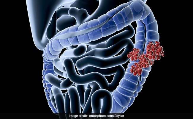 Colon Cancer Deaths Among Younger Adults Are Higher In Those With Less Education: Study
