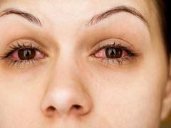 Conjunctivitis: 5 Home Care Remedies To Relieve Symptoms For This Eye Infection