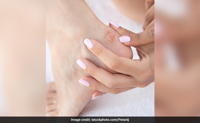 This is how to get rid of cracked heels