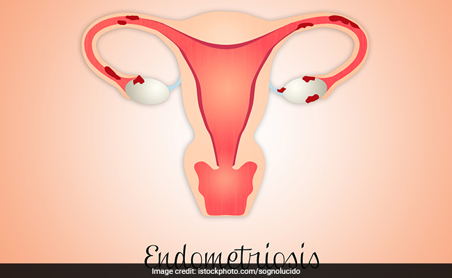 Endometriosis: Your Complete Guide To Endometriosis