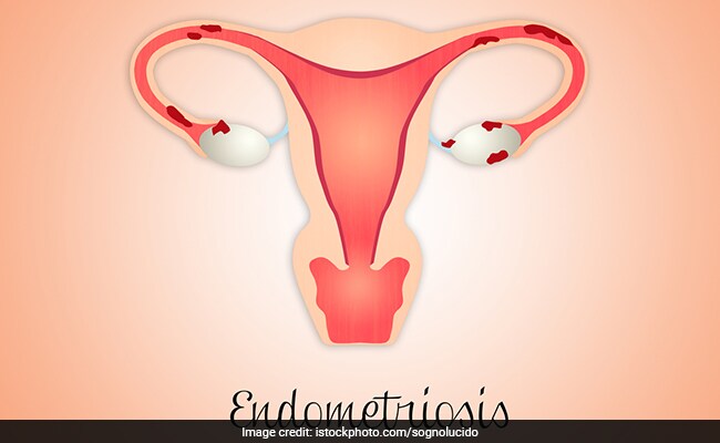 What Is Endometriosis: Causes Symptoms And Treatment Tips