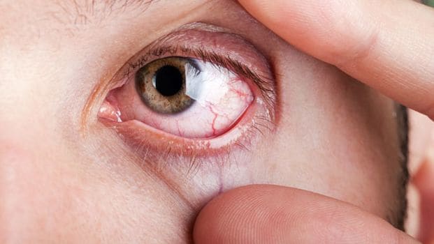 Eye Health : डोळ्यात अंजन घालणारा सर्व्हेक्षण; पुण्यातील IT क्षेत्रातील 46 टक्के तरुणांचे डोळे धोक्यात