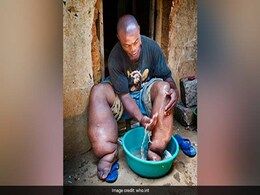 Elimination Of Lymphatic Filariasis: Here's How Karnataka Health Officials Are Ensuring Lymphatic Filariasis Doesn't Spread Elimination Of Lymphatic Filariasis: Here's How Karnataka Health Officials Are Ensuring Lymphatic Filariasis Doesn't Spread