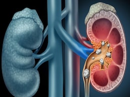 Kidney Stones Causes: ये 6 चीजें बनाती हैं किडनी में स्टोन, आज से ही इनको खाना छोड़ दें, वर्ना डैमेज हो जाएंगी किडनियां Kidney Stones Causes: ये 6 चीजें बनाती हैं किडनी में स्टोन, आज से ही इनको खाना छोड़ दें, वर्ना डैमेज हो जाएंगी किडनियां