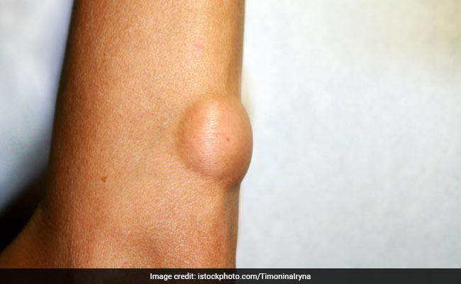 Penile bumps shaft treatment on Bumps on