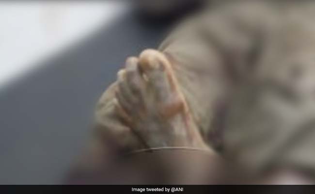 In Uttar Pradesh's Sultanpur, Doctors Leave Severed Foot On Patient