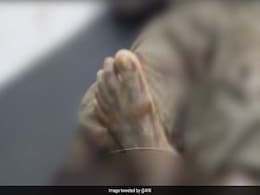 In Uttar Pradesh's Sultanpur, Doctors Leave Severed Foot On Patient In Uttar Pradesh's Sultanpur, Doctors Leave Severed Foot On Patient