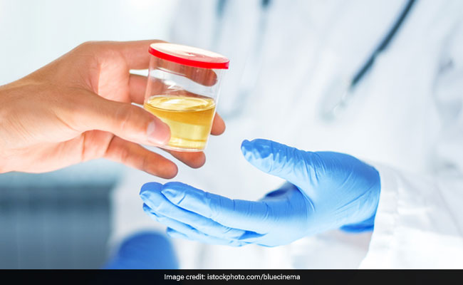 5 Natural Ways To Lower Your Uric Acid Levels: Know The Causes And Risk Factors