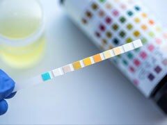 Simple Urine Test May Predict Biological Age, Death