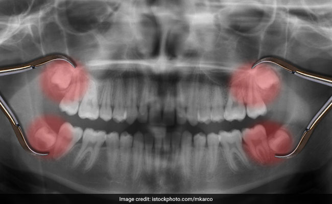 Wisdom Teeth आने पर क्यों होता है दांतों में तेज दर्द? क्या अकल दाड़ से बढ़ती है बुद्धि, जानिए क्या है इसका काम