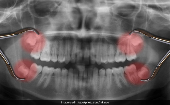 Easiest And Effective Home Remedies For Wisdom Tooth Pain Easiest And Effective Home Remedies For Wisdom Tooth Pain