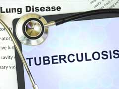 World Tuberculosis Day 2024: Follow These Prevention Tips To Reduce Your Risk Of TB