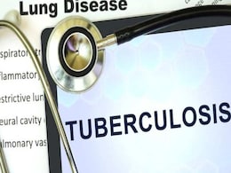Aspirin Can Aid In Fight Against Tuberculosis: Study Aspirin Can Aid In Fight Against Tuberculosis: Study