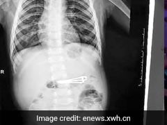 1-Year-Old Boy Swallowed A Nail Clipper. How It Was Removed