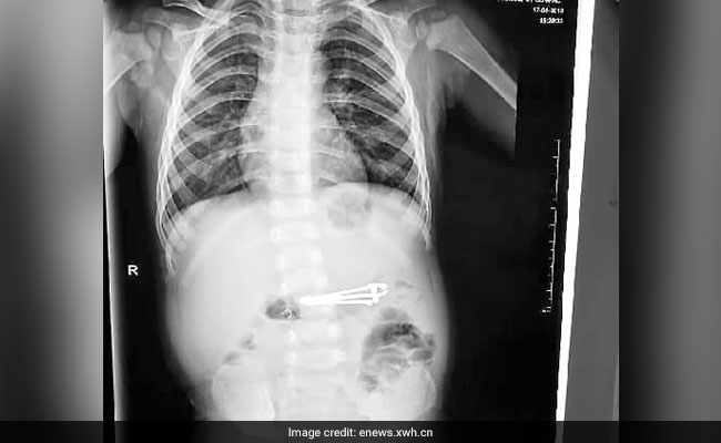 1-Year-Old Boy Swallowed A Nail Clipper. How It Was Removed