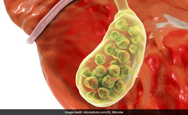 किस वजह से बनती है पित्त की थैली में पथरी? जानिए पित्ताशय की पथरी के लक्षण, कारण और इलाज के बारे में सब कुछ