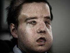 ''The Man With Three Faces'' Has Second Transplant