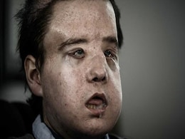 ''The Man With Three Faces'' Has Second Transplant ''The Man With Three Faces'' Has Second Transplant