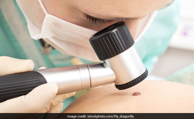 How To Differentiate Between A Cancerous And Benign Mole