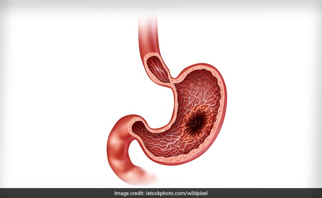 5 Habits That Increase Your Chances Of Developing Stomach Cancer