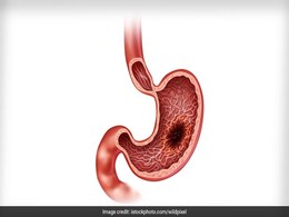 Stomach Cancer: 5 Things You Need To Know Stomach Cancer: 5 Things You Need To Know