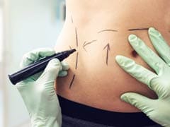 Liposuction: 5 Popular Myths Busted