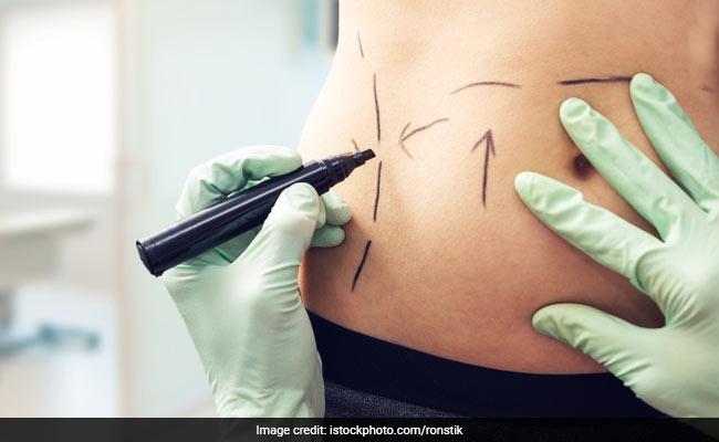 Liposuction: 5 Popular Myths Busted