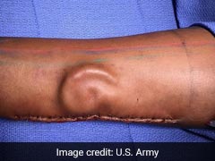 A Soldier Needed An Ear Transplant. Doctors 'Grew' A New One In Her Arm