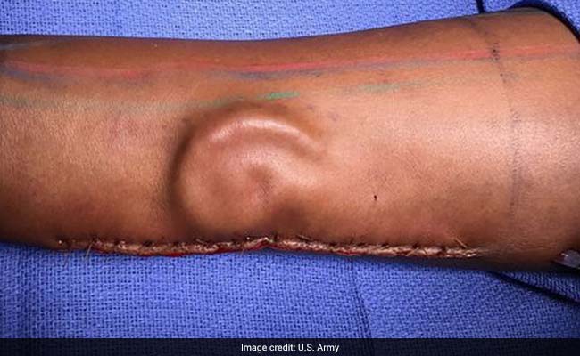 A Soldier Needed An Ear Transplant. Doctors 'Grew' A New One In Her Arm