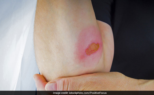 Skin Burns: Top 10 Home Remedies