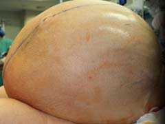 The Risky Surgery To Remove A Woman's 132-Pound Tumor That Grew By 10 Pounds Every Week