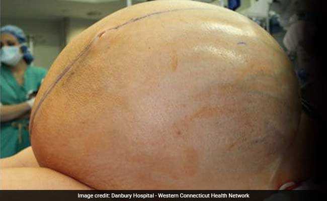 The Risky Surgery To Remove A Woman's 132-Pound Tumor That Grew By 10 Pounds Every Week