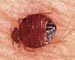 Summit to address bed bug outbreak