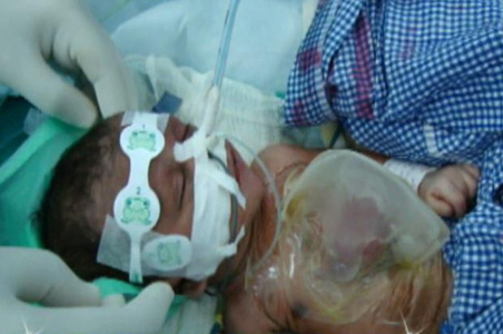 India's miracle baby dies in hospital, age 22 days