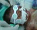 India's miracle baby dies in hospital, age 22 days