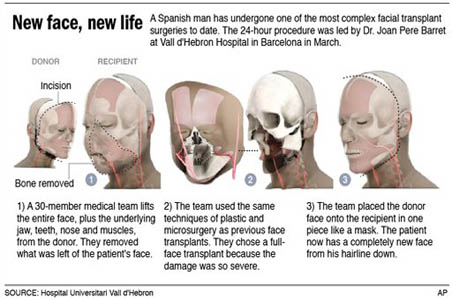 World's first full face transplant in Spain