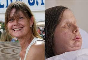 Chimpanzee attack victim gets a new face