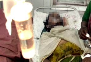 Sitapur: Dalit girl set on fire for resisting rape
