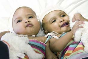 UK surgeons separate twin girls joined at head