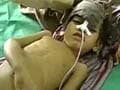 Encephalitis kills 376 children in eastern UP, spreads to Delhi