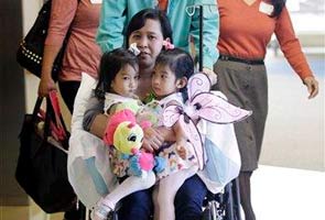 2-year-old twins joined at chest  to undergo surgery 