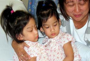 Filipino-born conjoined twins separated after 9-hour operation