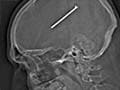 Three inch nail removed from man's brain
